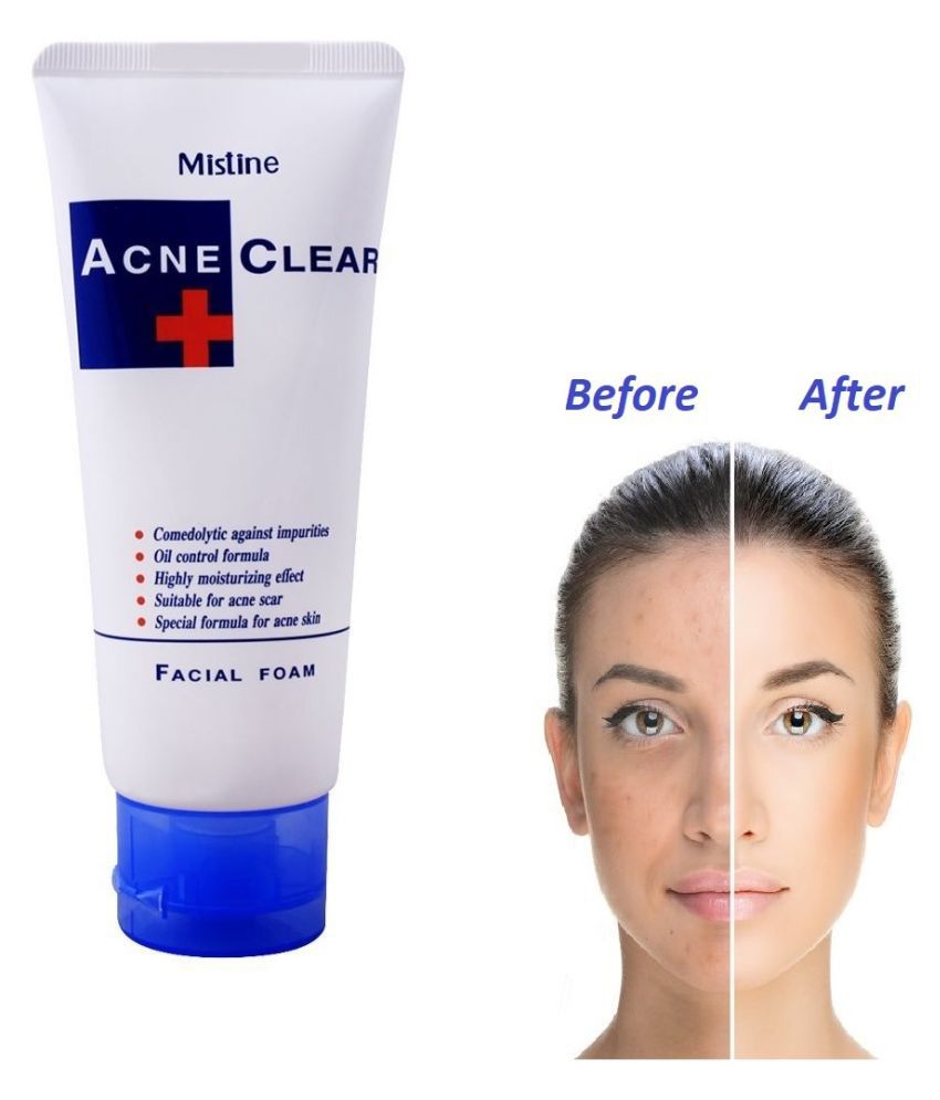 Mistine ACNE Clear Facial Foam Face Wash Thailand 85Gms