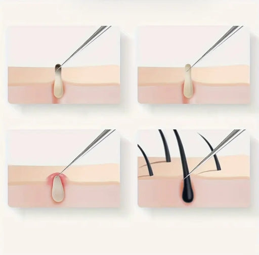 4Pcs/3pcs Ance Blackhead Removal Tool Kit for Face Care Needle Stainless Steel Whitehead Pimple Pore