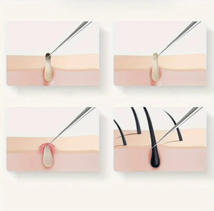 4Pcs/3pcs Ance Blackhead Removal Tool Kit for Face Care Needle Stainless Steel Whitehead Pimple Pore