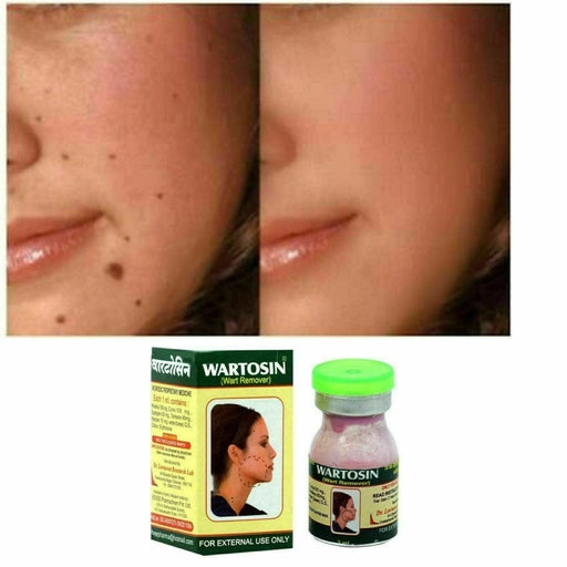 Moisturizers and Cream ( Wart Remover) 3Ml